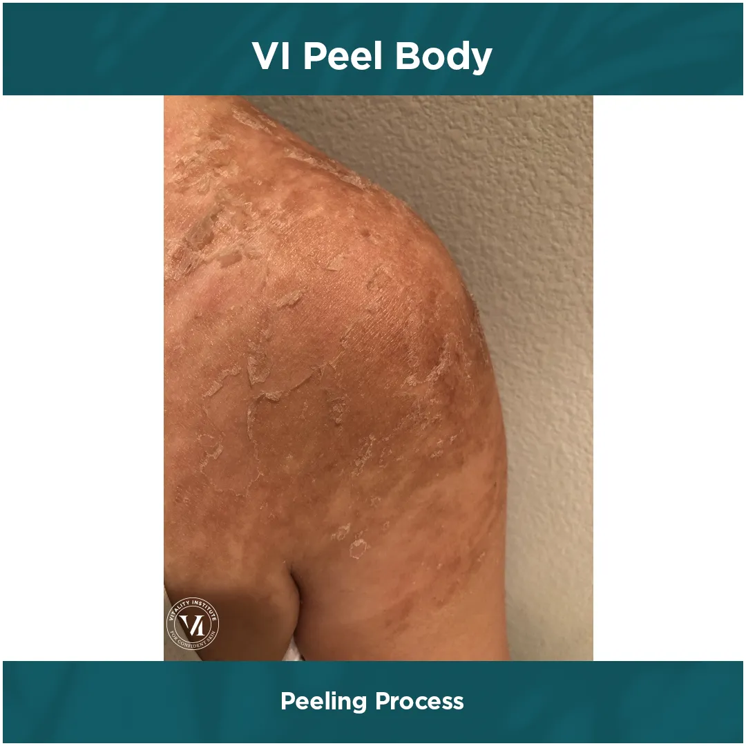 Peeling Process — Shoulder, Heavy Peel