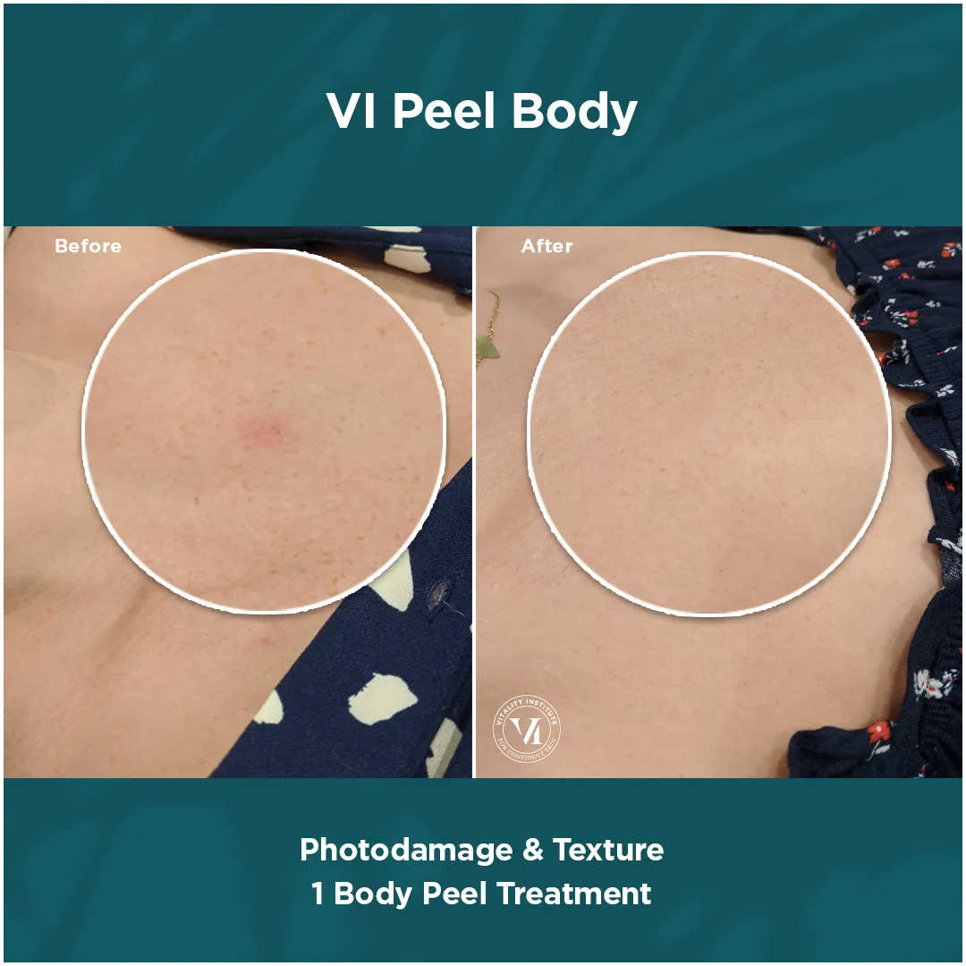 Photodamage & Texture — 1 VI Peel Body Treatment