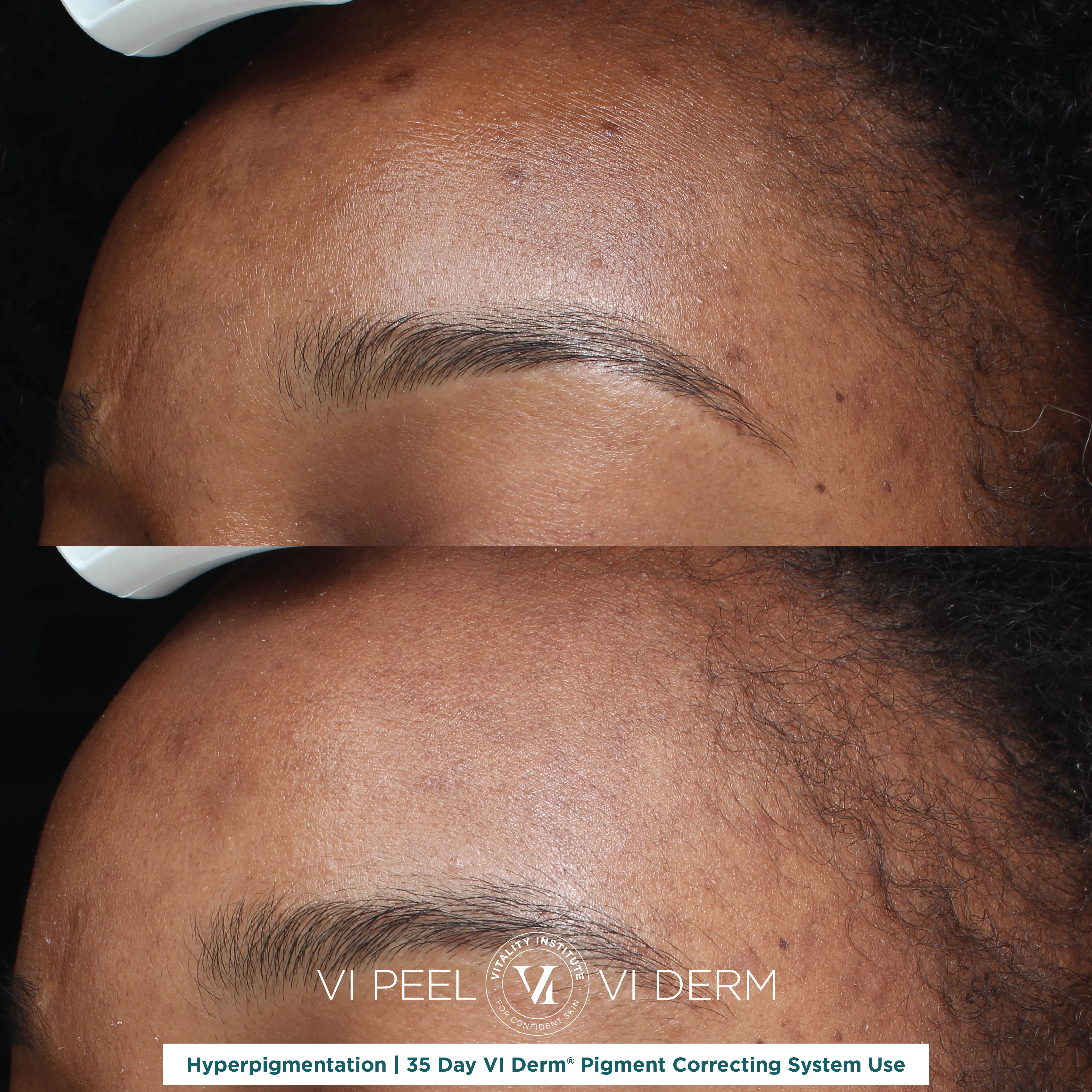 Hyperpigmentation — VI Derm Pigment Correcting System, 35 Days