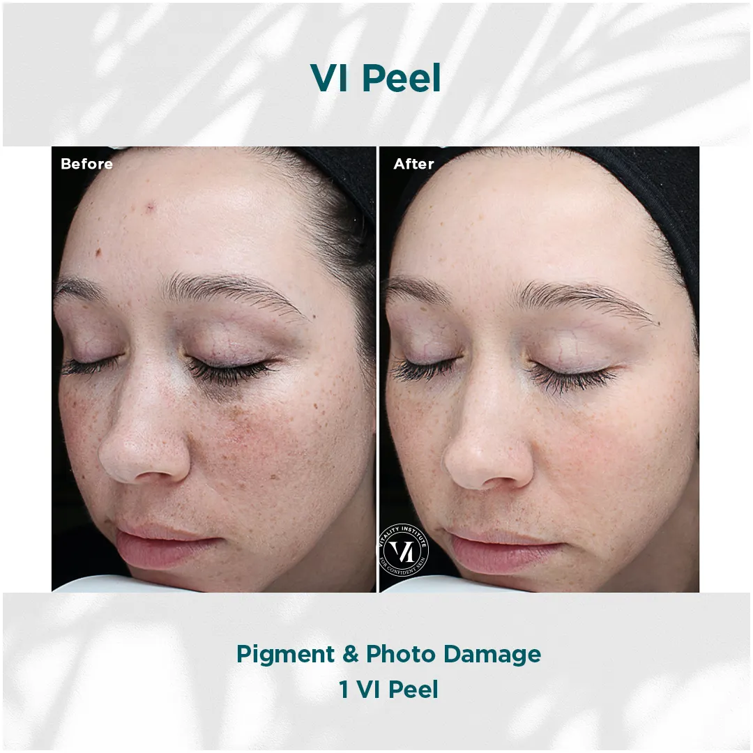 Pigment & Photo Damage — 1 VI Peel