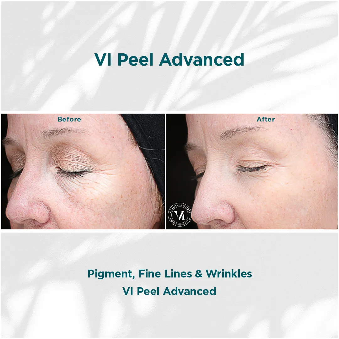 Pigment, Fine Lines & Wrinkles — 1 VI Peel Advanced