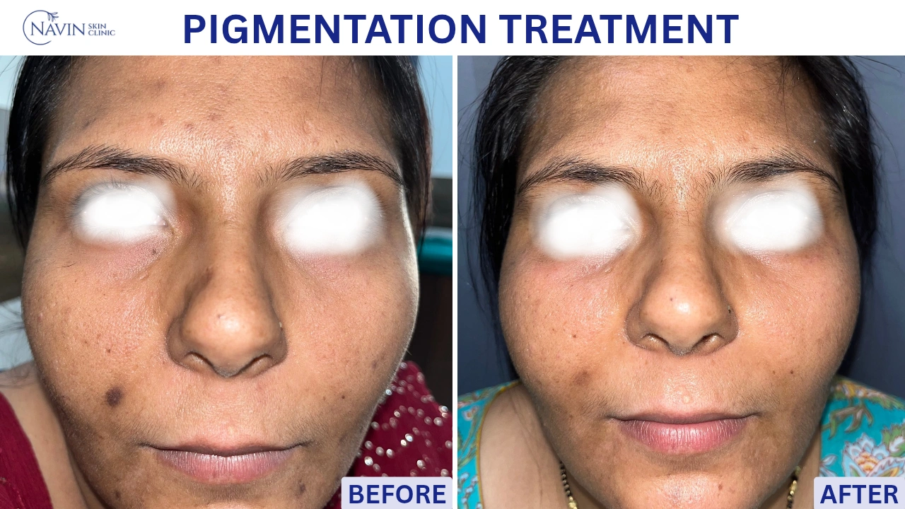 Pigmentation Treatment - Before