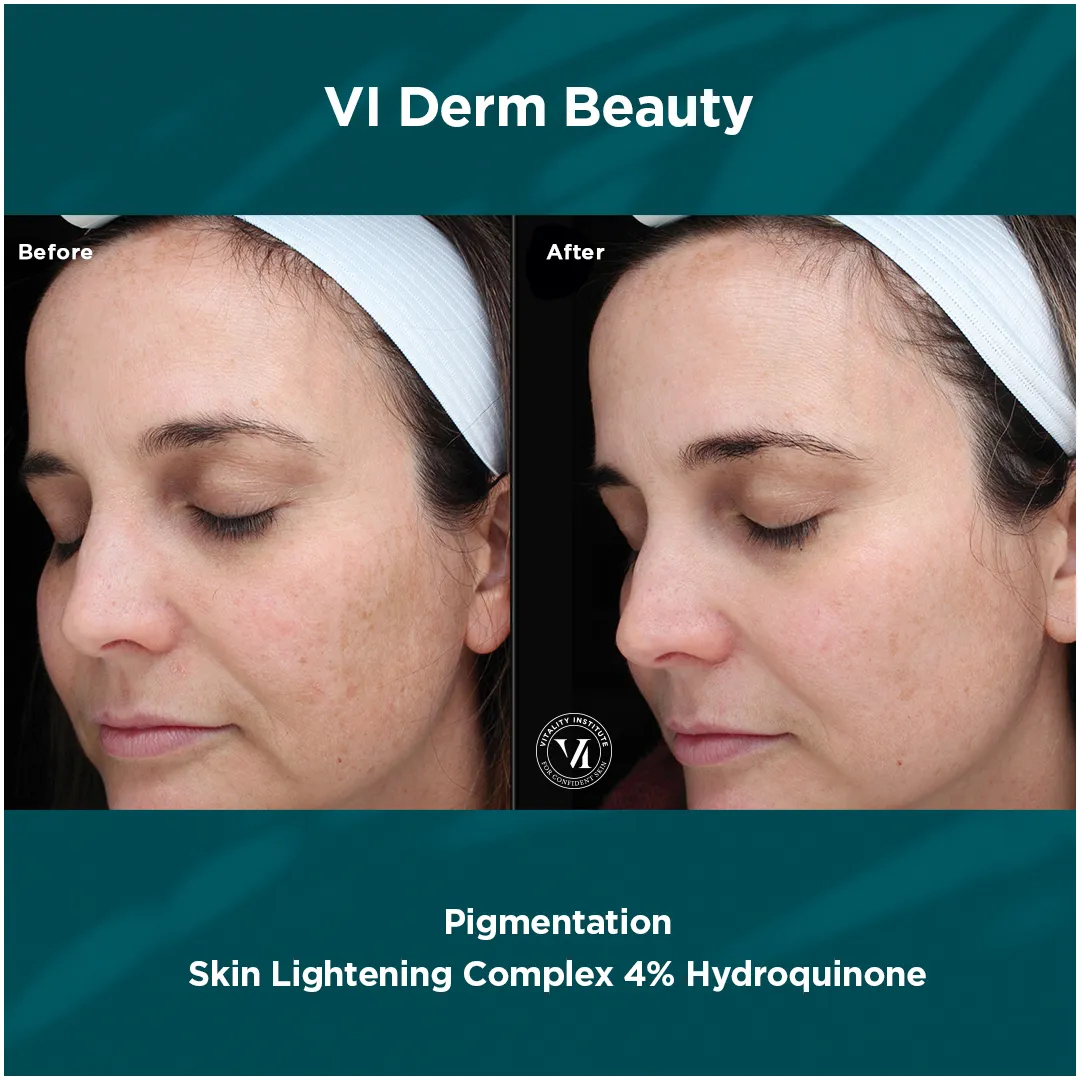 Pigmentation — VI Derm Skin Lightening Complex 4% Hydroquinone (II)