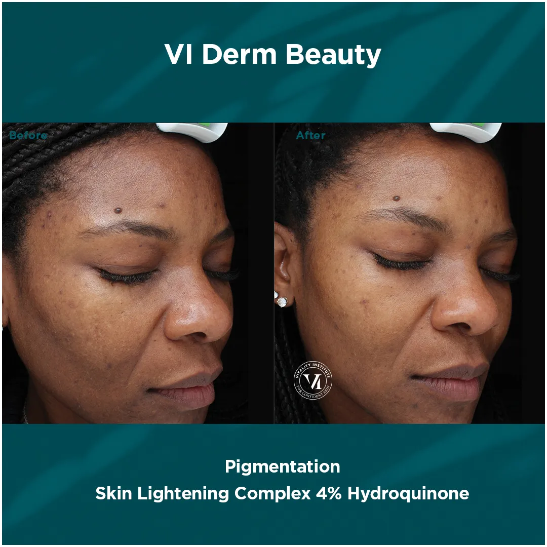 Pigmentation — VI Derm Skin Lightening Complex 4% Hydroquinone (IV)
