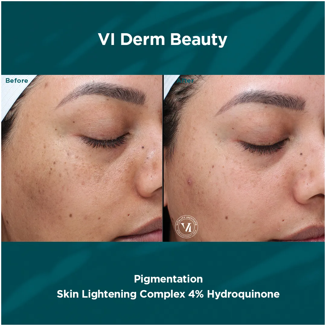 Pigmentation — VI Derm Skin Lightening Complex 4% Hydroquinone (VI)