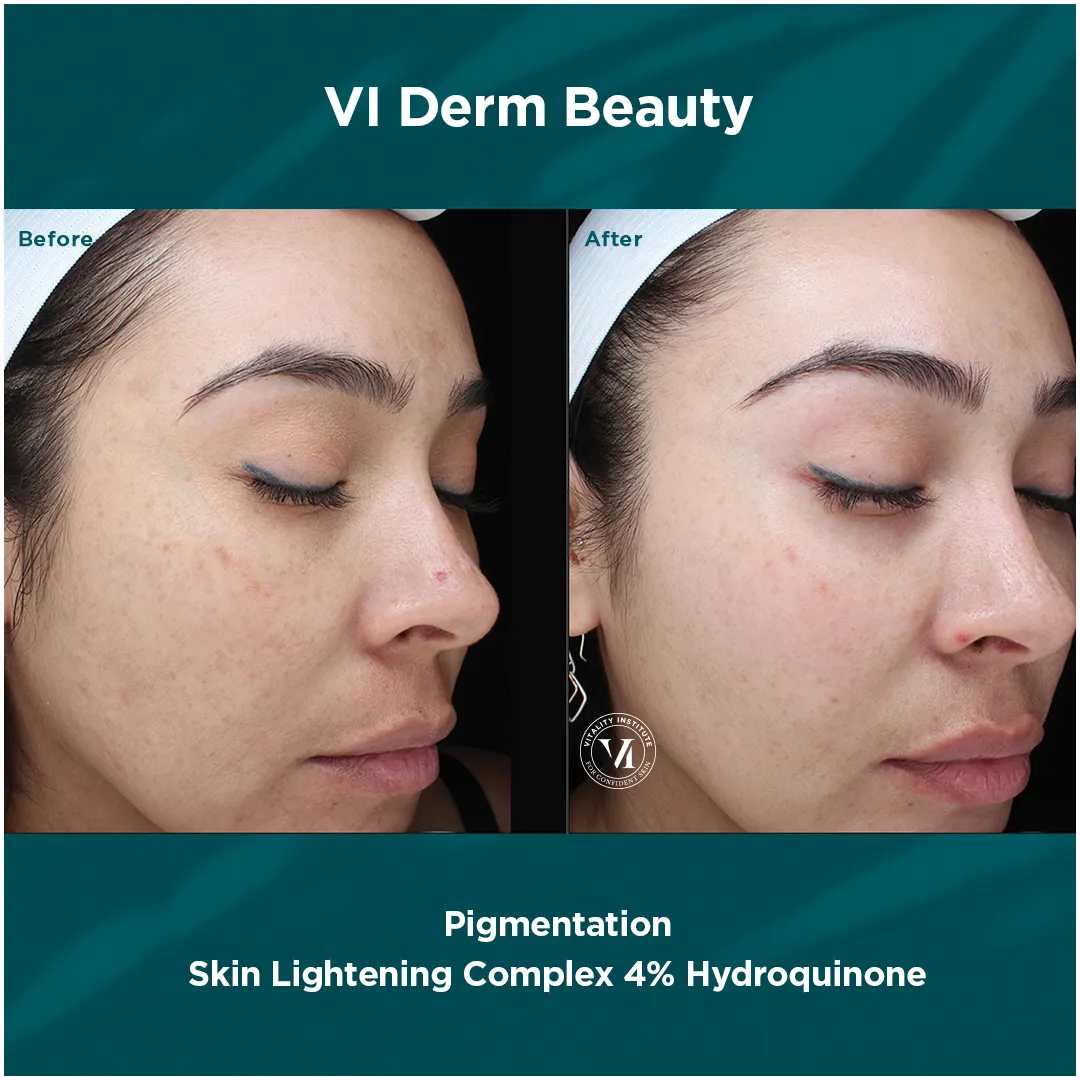 Pigmentation — VI Derm Skin Lightening Complex 4% Hydroquinone (III)