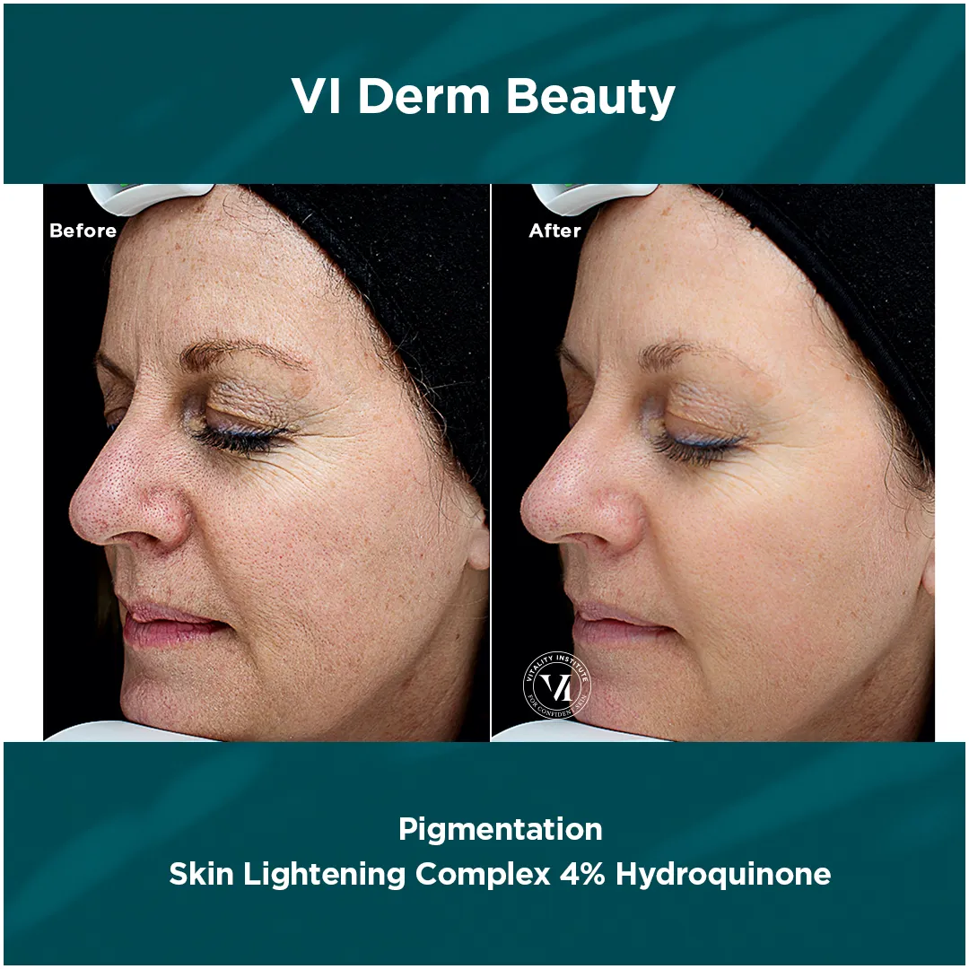 Pigmentation — VI Derm Skin Lightening Complex 4% Hydroquinone (I)