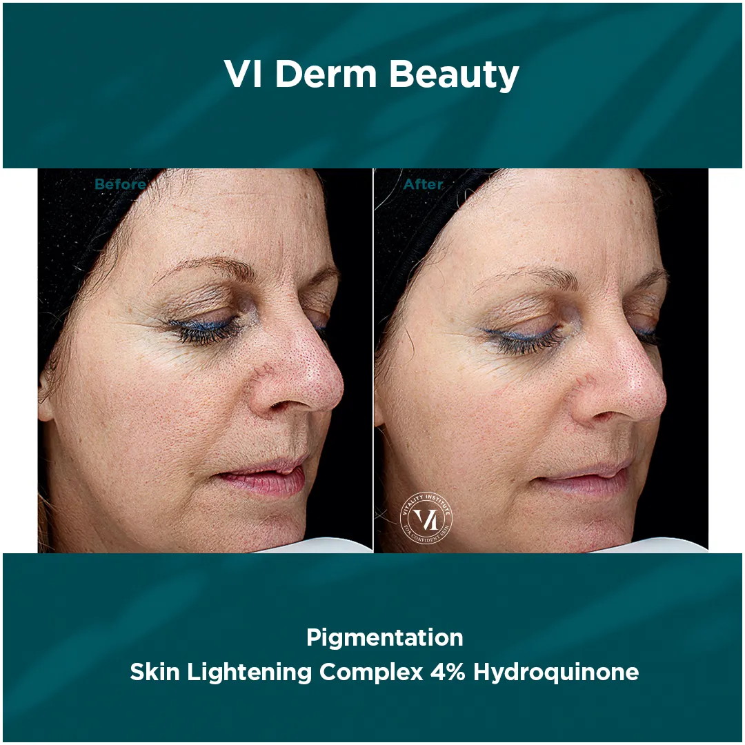 Pigmentation — VI Derm Skin Lightening Complex 4% Hydroquinone (V)