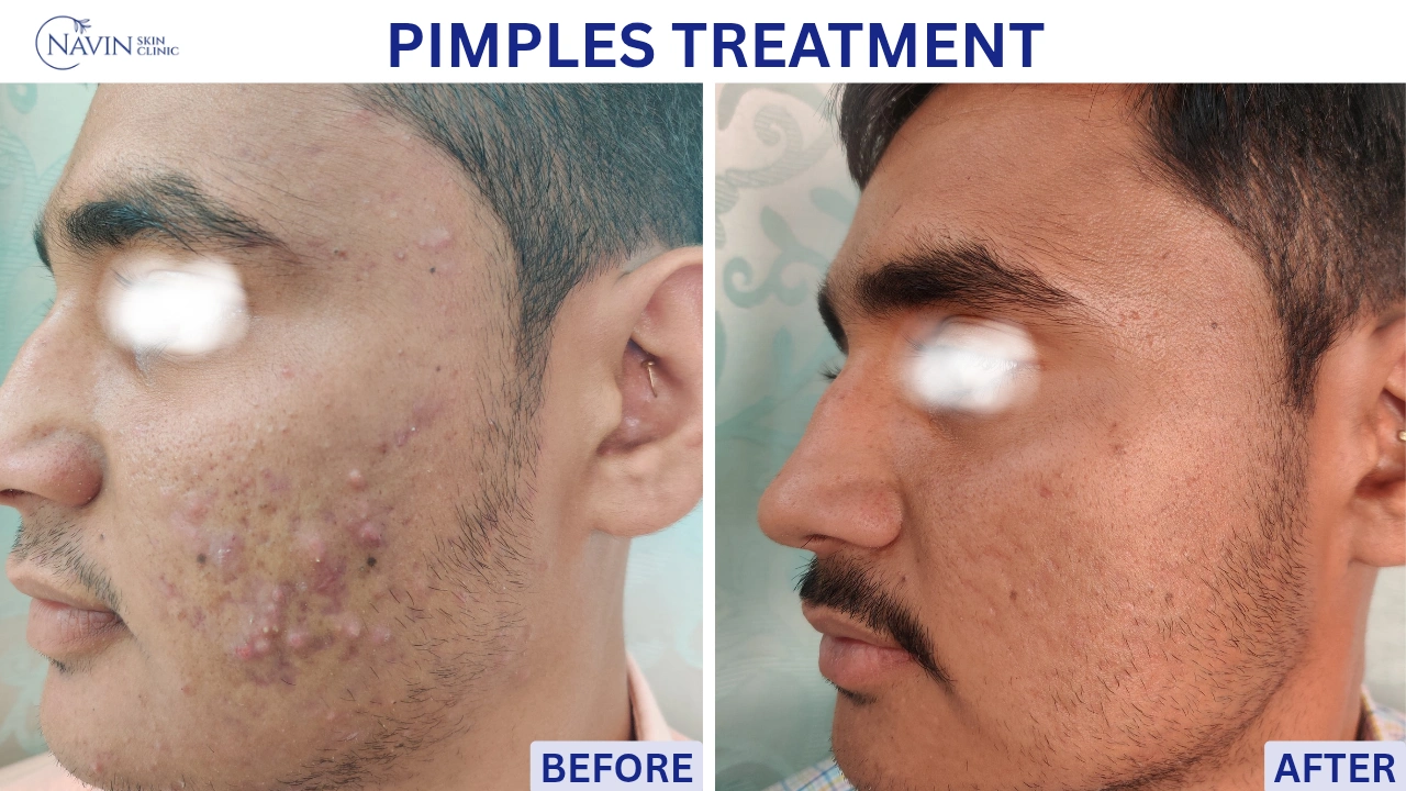 Pimples Treatment - Before