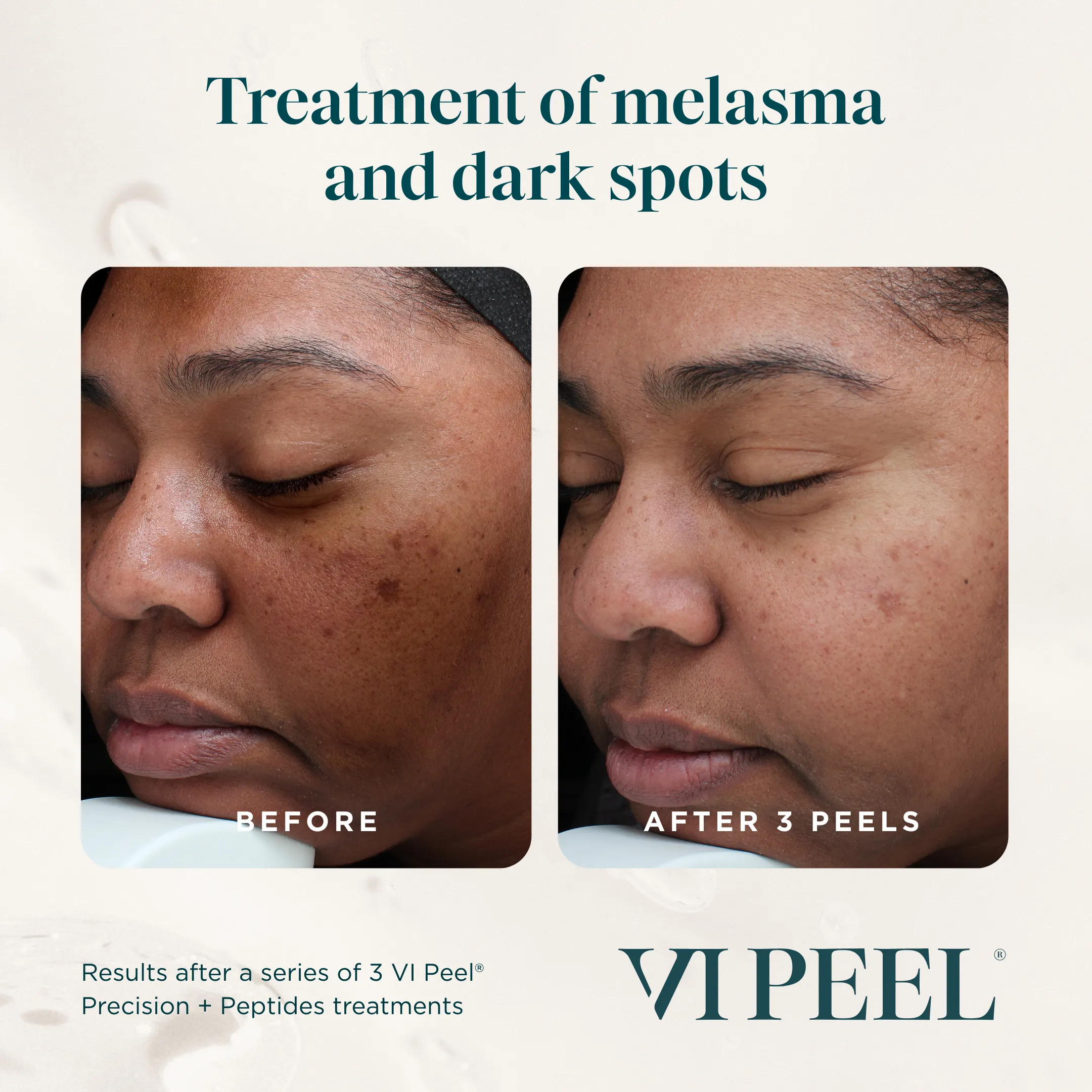 Melasma & Fine Lines — VI Peel Precision + Peptides, 3 Sessions (Progression)