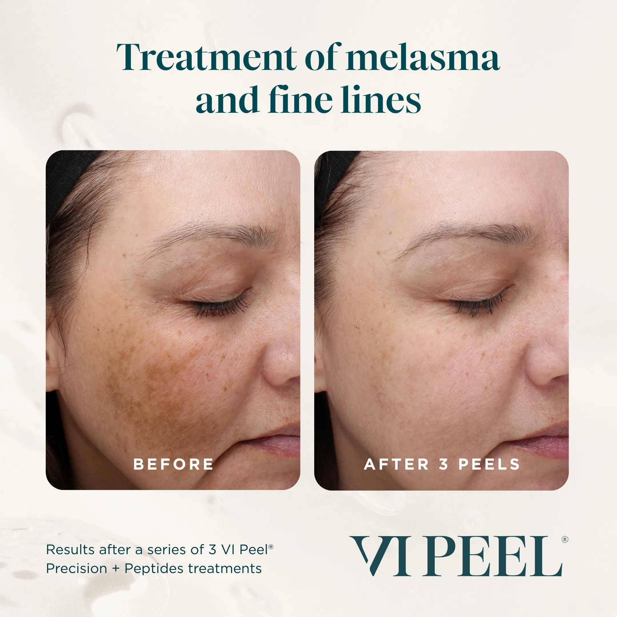 Melasma & Fine Lines — VI Peel Precision + Peptides, Before vs After 3 Peels (II)