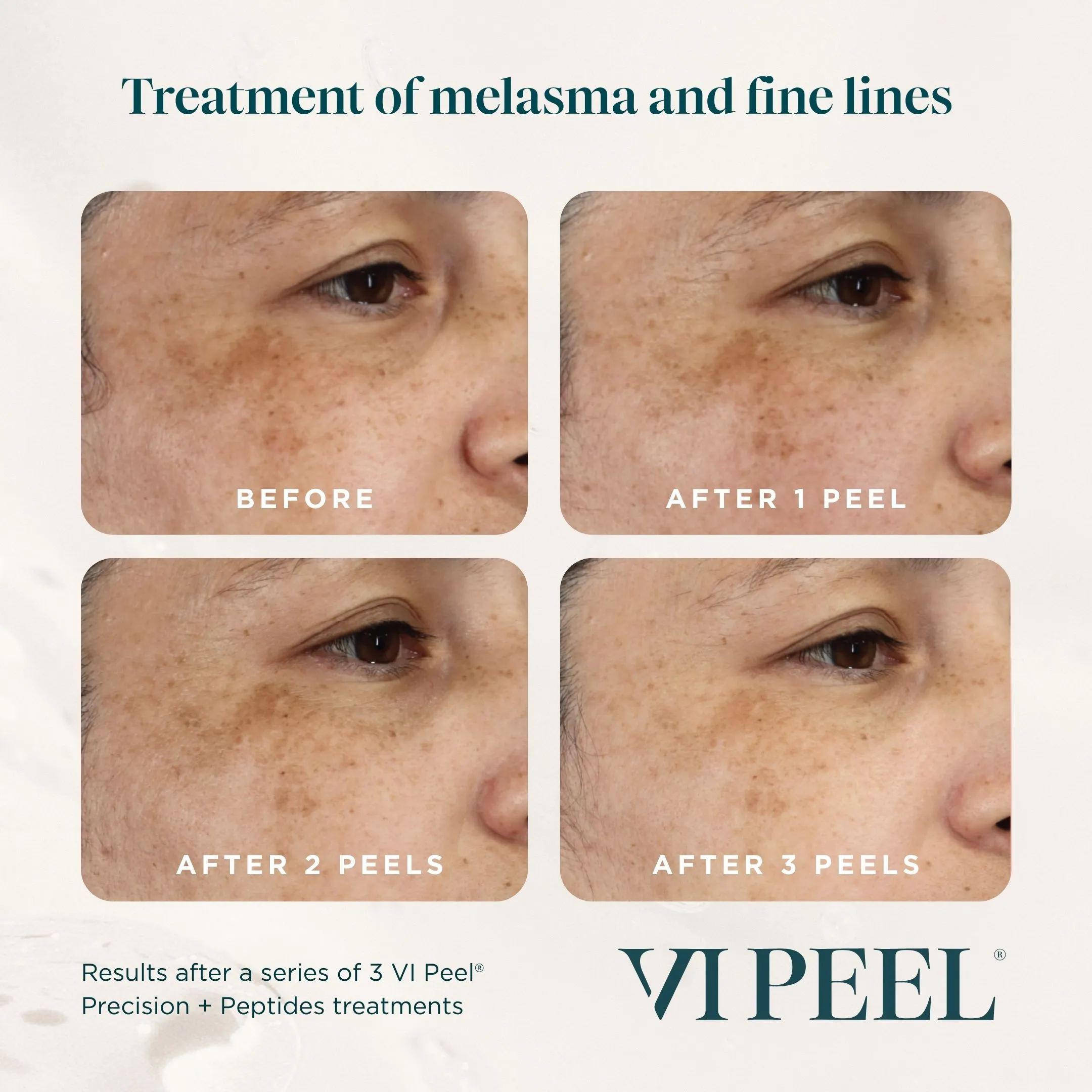 Melasma & Fine Lines — VI Peel Precision + Peptides, Before vs After 3 Peels