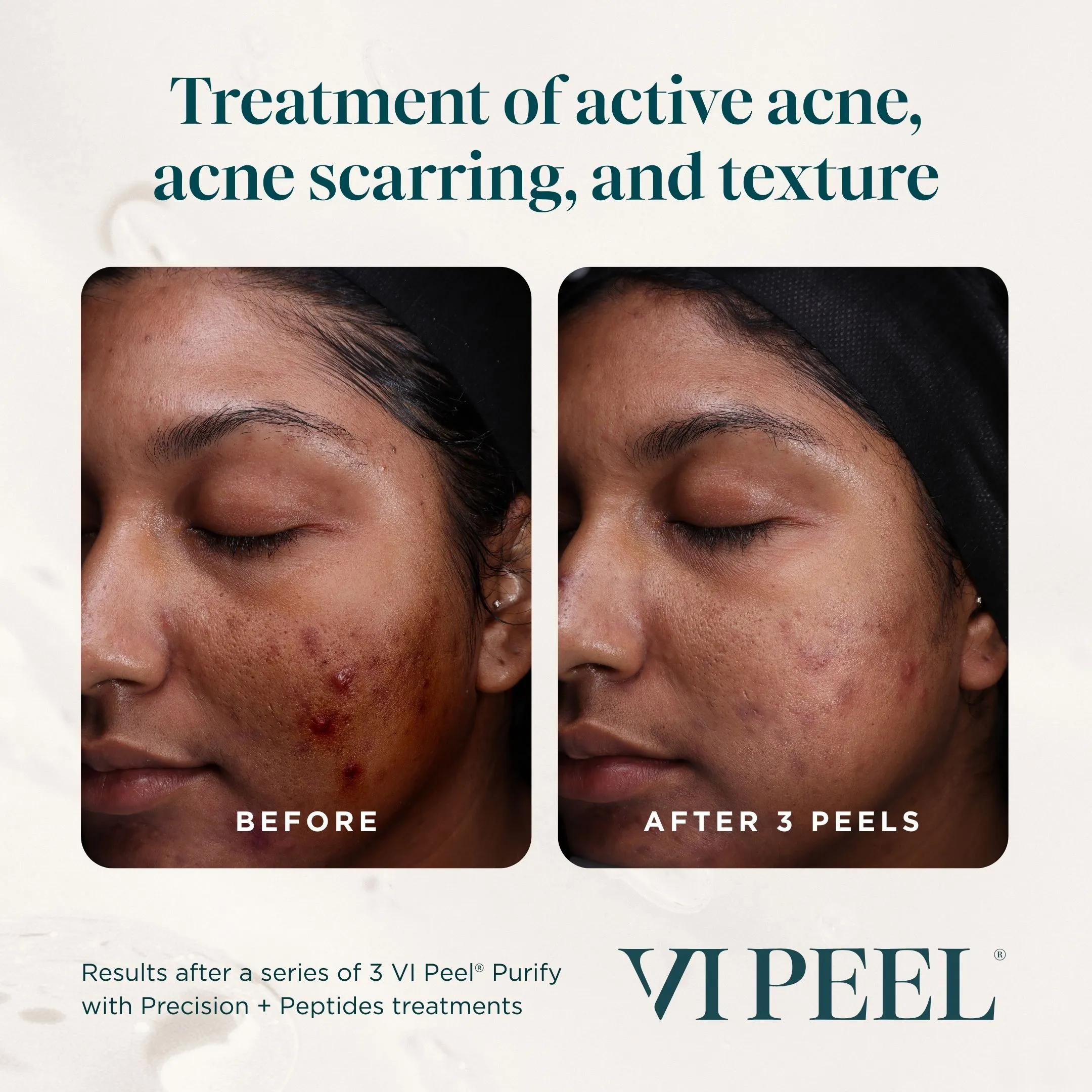 Active Acne, Scarring & Texture — VI Peel Purify with Precision + Peptides, 3 Sessions