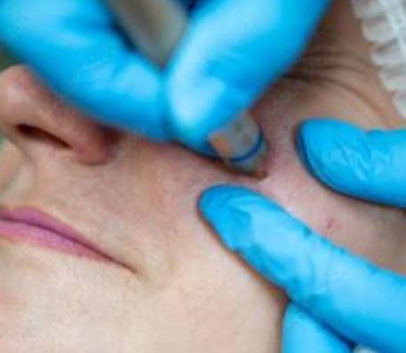 Rosacea Behandlung