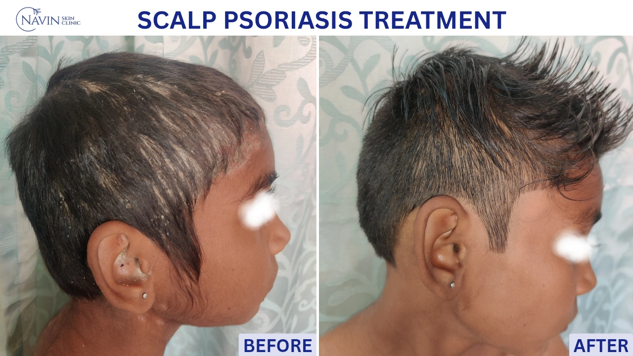 Scalp Psoriasis Treatment - Before