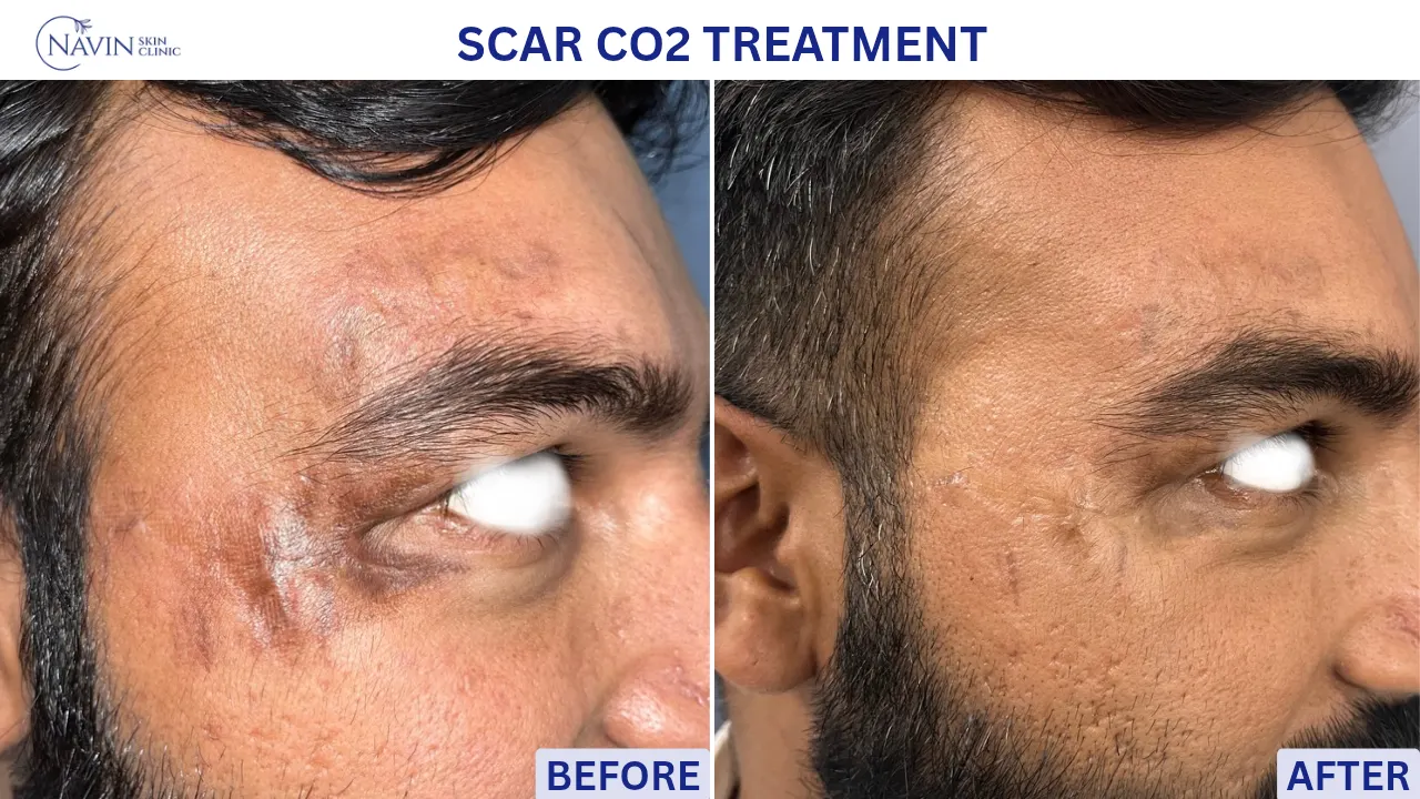 Scar CO2 Treatment - Before