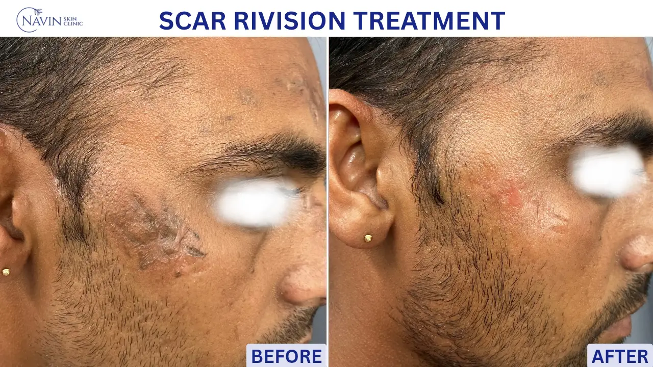 Scar Revision Treatment - Before