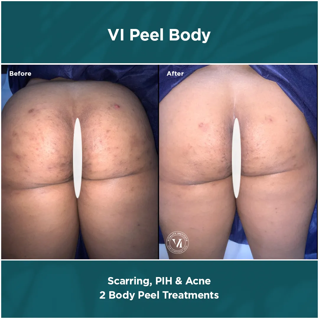 Scarring, PIH & Acne — Buttocks, 2 VI Peel Body Treatments