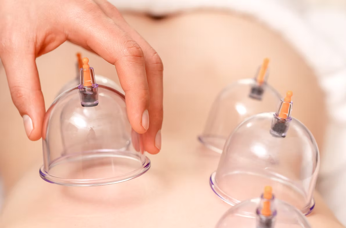 Schröpfen Behandlung - Heilpraktiker Recklinghausen Gordon Handle