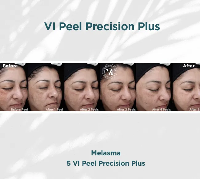 Melasma — 5 VI Peel Precision Plus (Progressive Series)