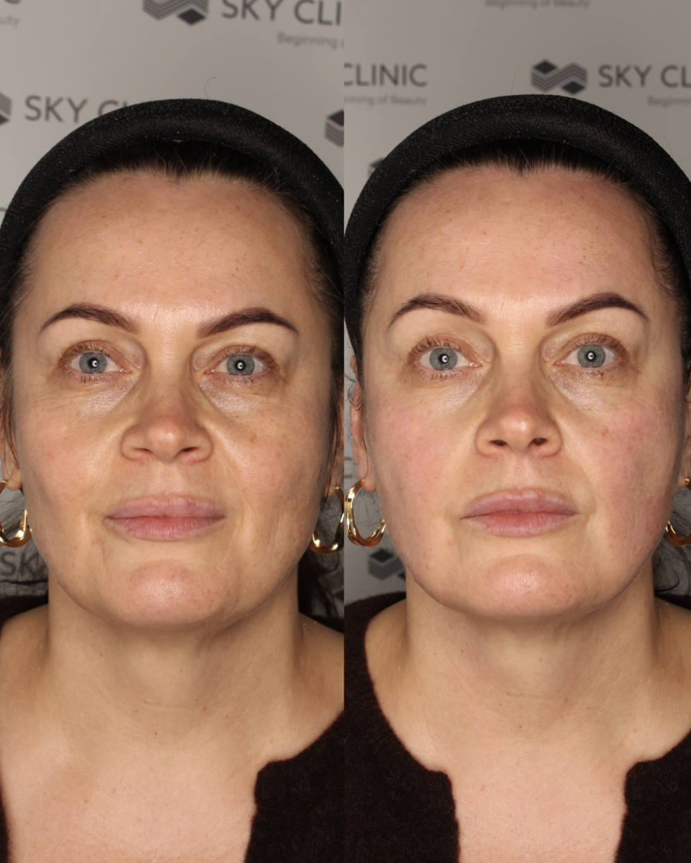 Lifting bez skalpela