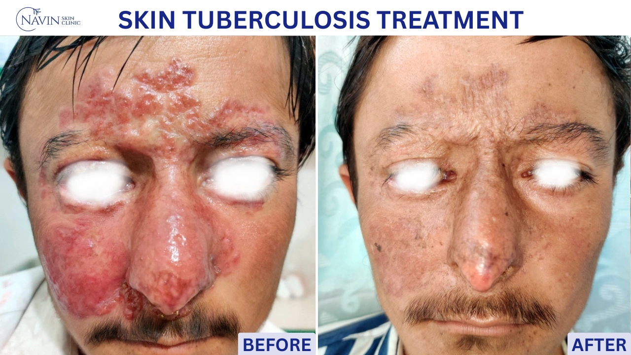 Skin Tuberculosis Treatment - Before