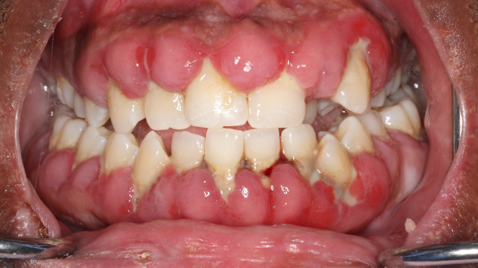 Severe Dilantin induced gingival hyperplasia