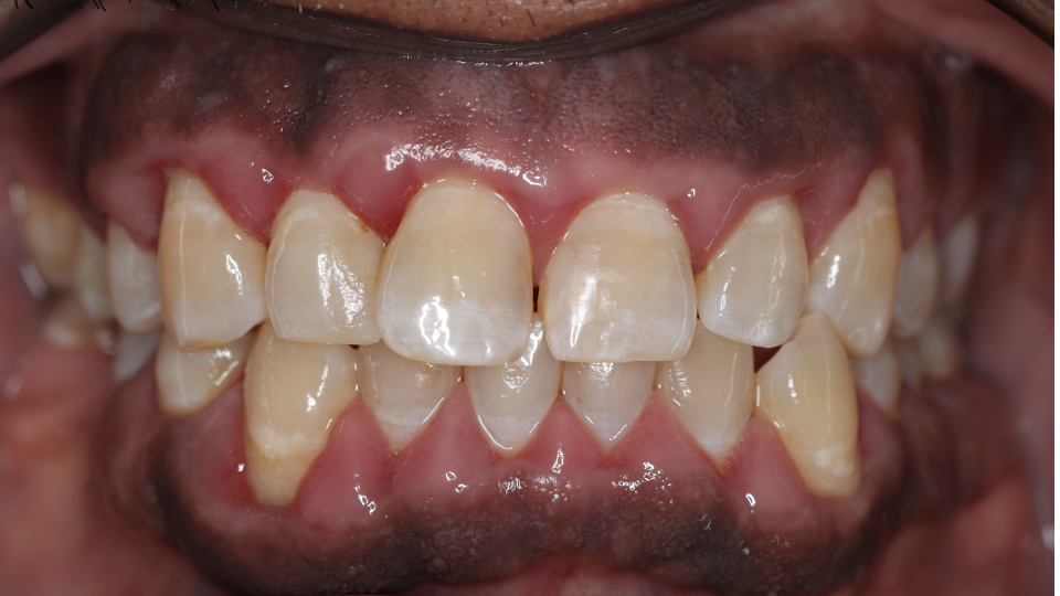 Moderate Amlodipine induced gingival hyperplasia