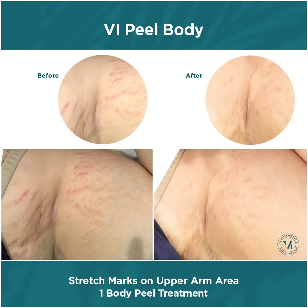 Stretch Marks — Upper Arm Area, 1 VI Peel Body Treatment