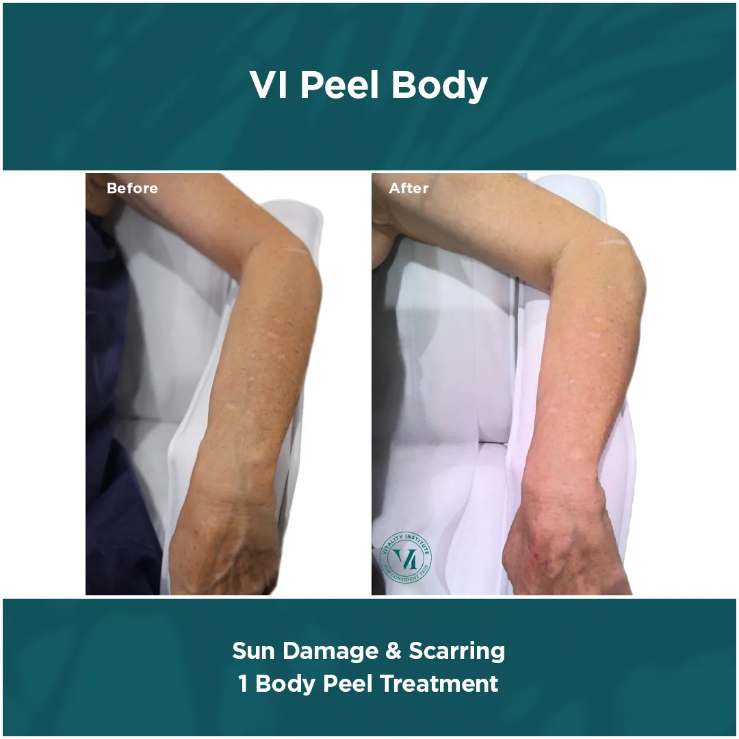 Sun Damage & Scarring — Forearm, 1 VI Peel Body Treatment