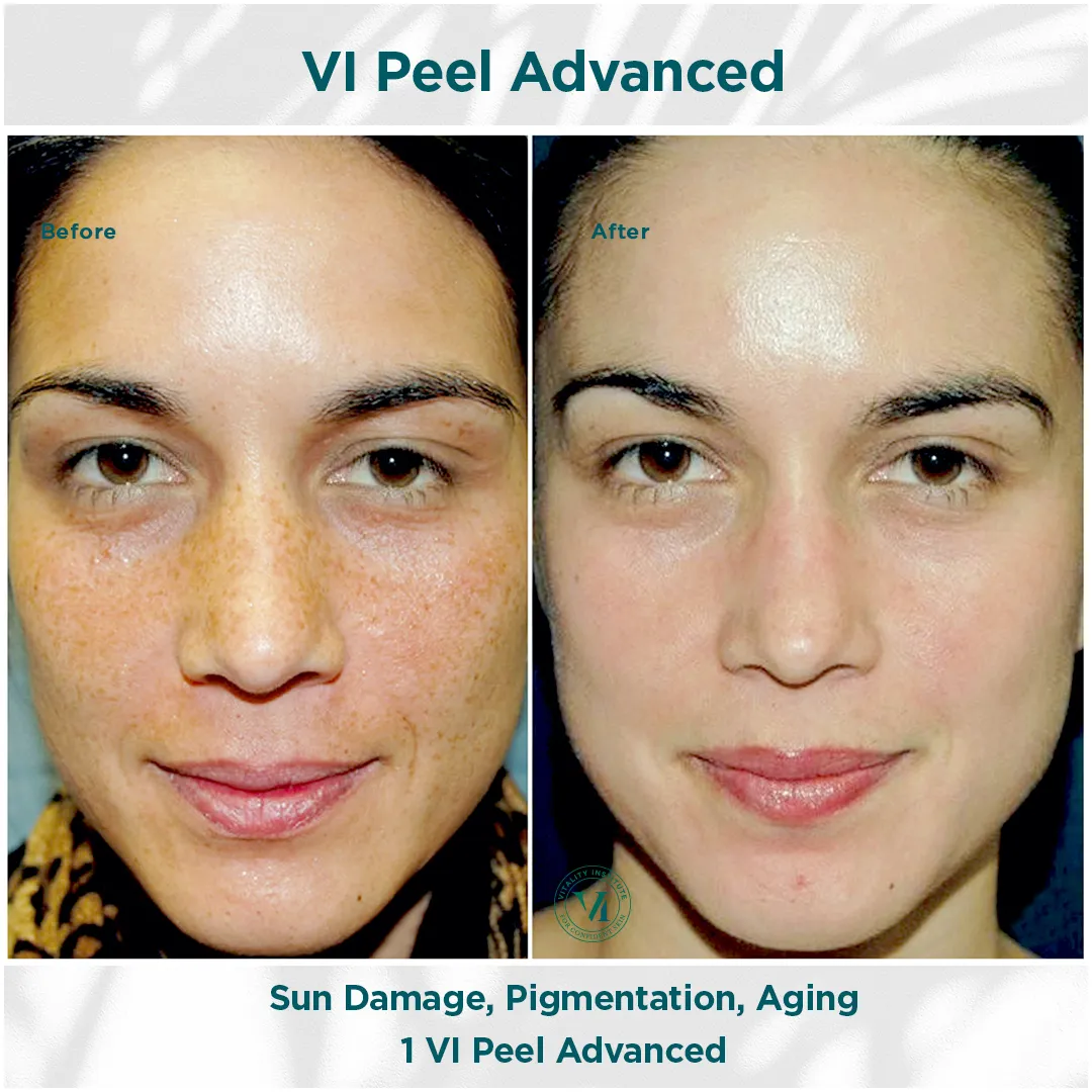 Sun Damage, Pigmentation & Aging — 1 VI Peel Advanced