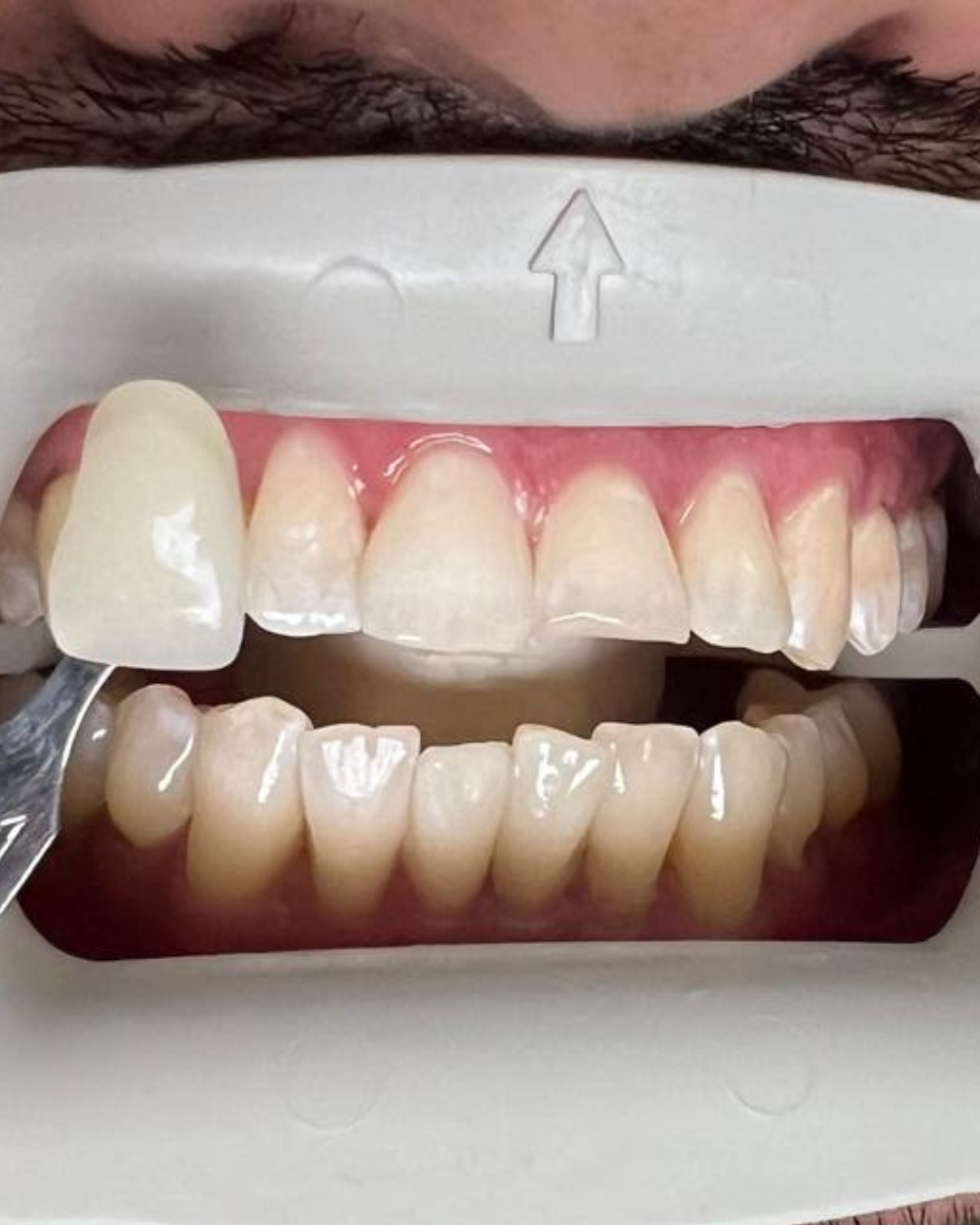 Teeth Whitening after