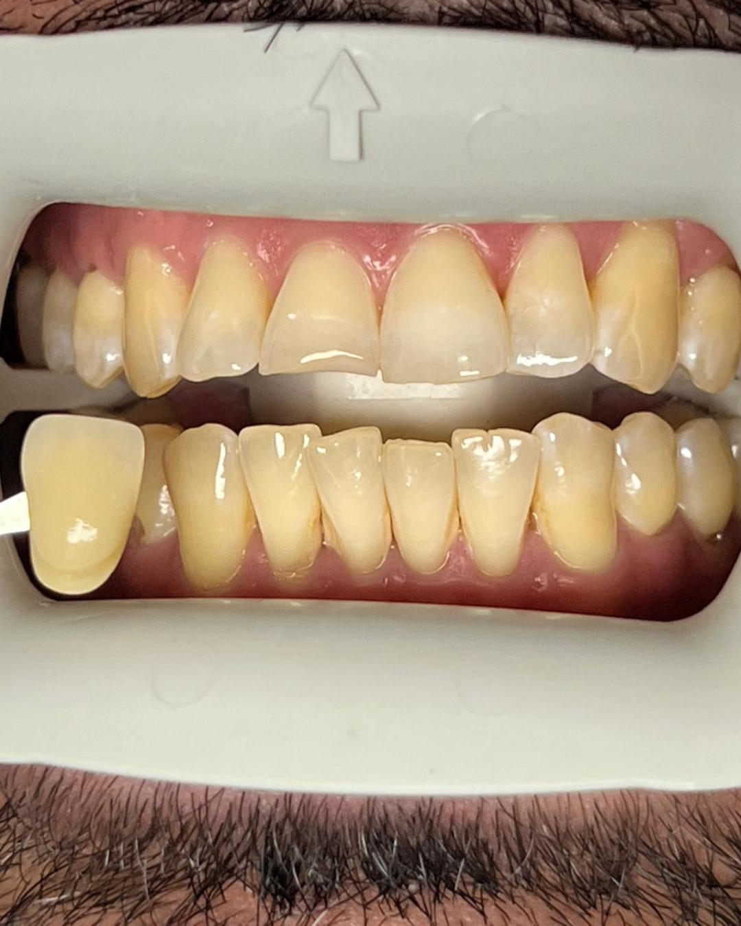 Teeth Whitening before