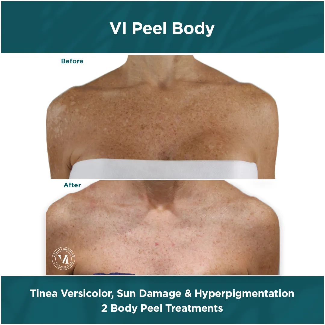 Tinea Versicolor, Sun Damage & Hyperpigmentation — Chest, 2 VI Peel Body Treatments
