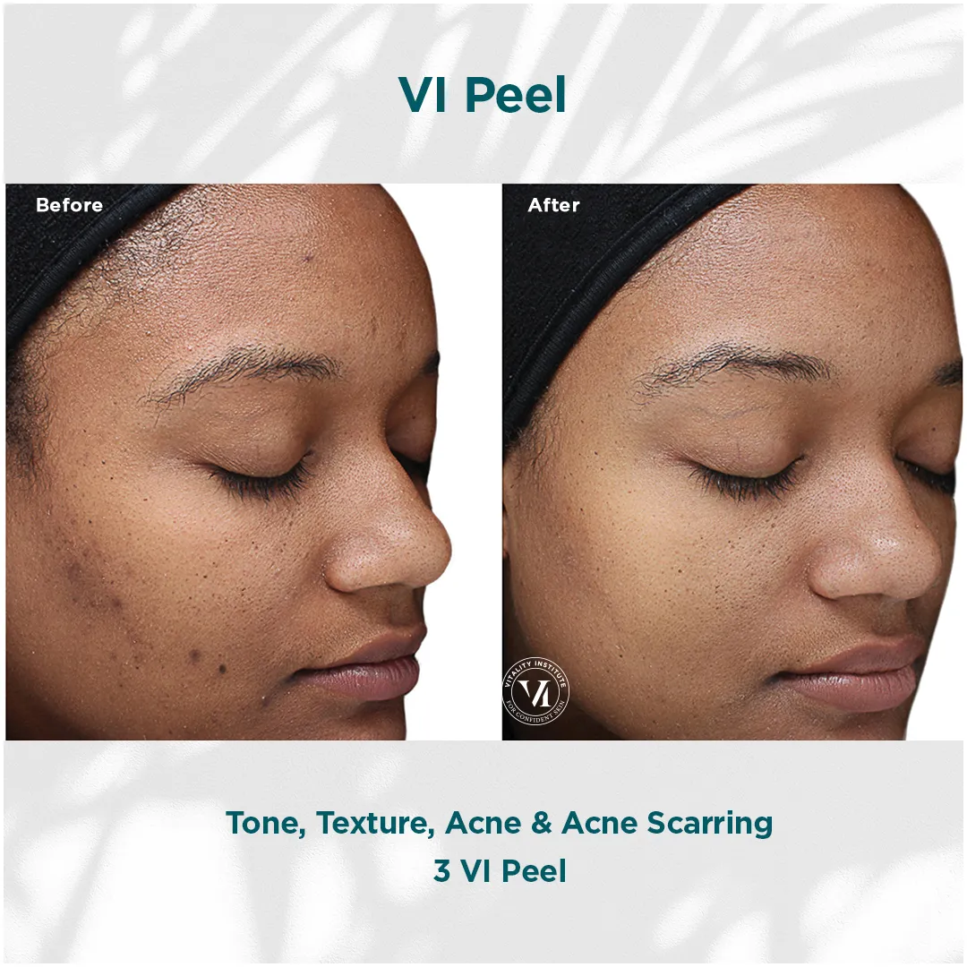 Tone, Texture, Acne & Acne Scarring — 3 VI Peel