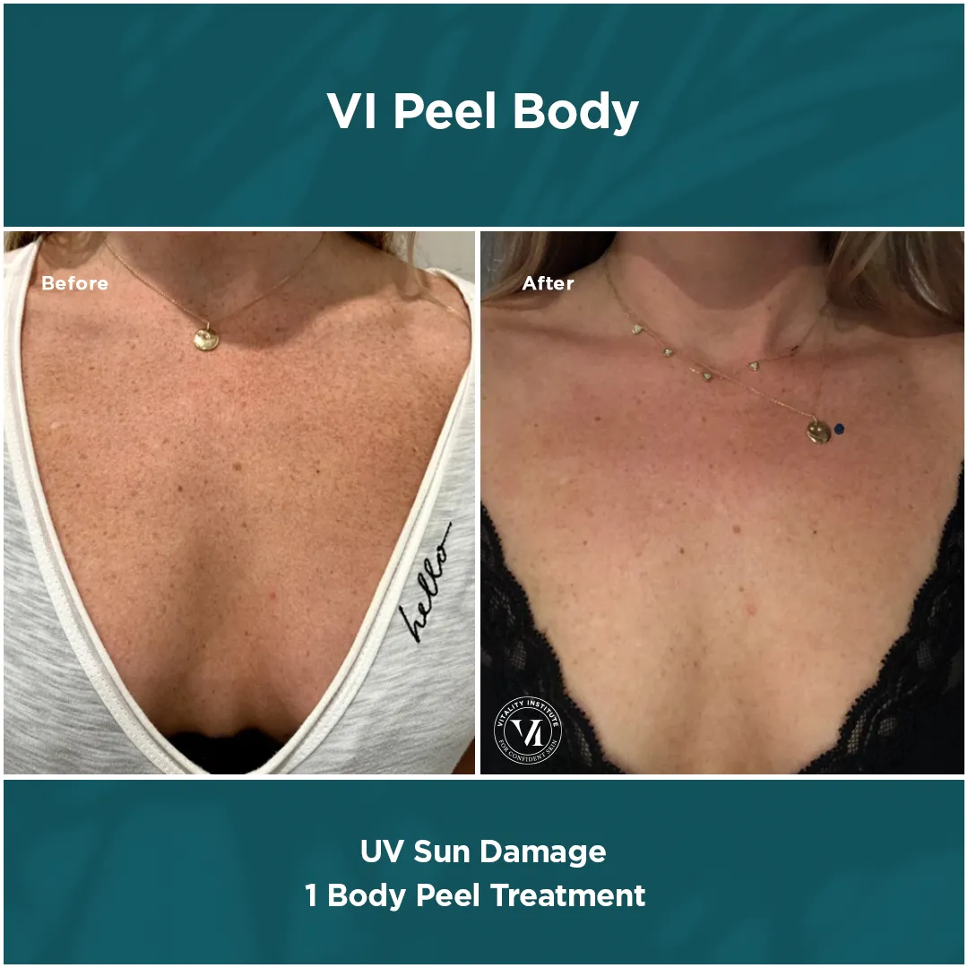UV Sun Damage — Chest & Décolleté, 1 VI Peel Body Treatment