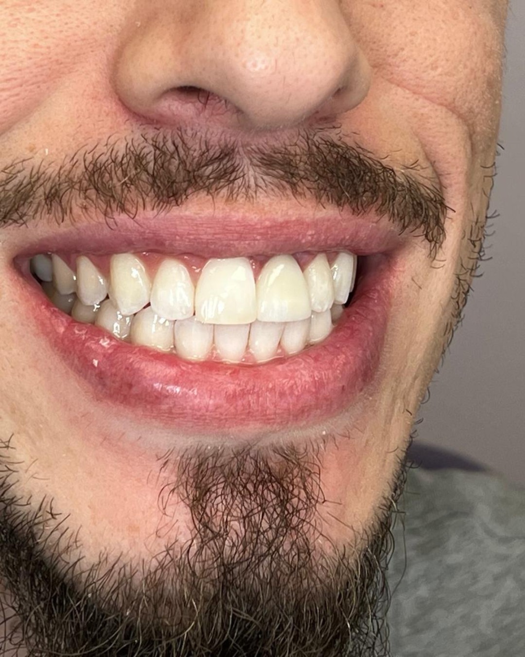 Upper Anterior Crown after