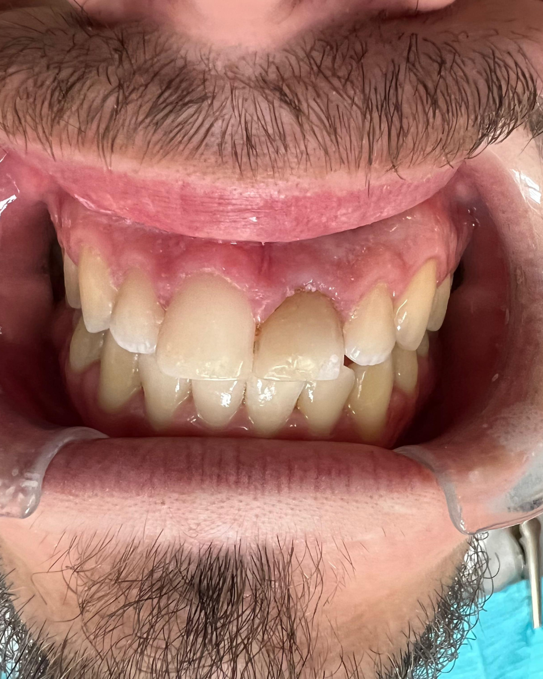 Upper Anterior Crown before
