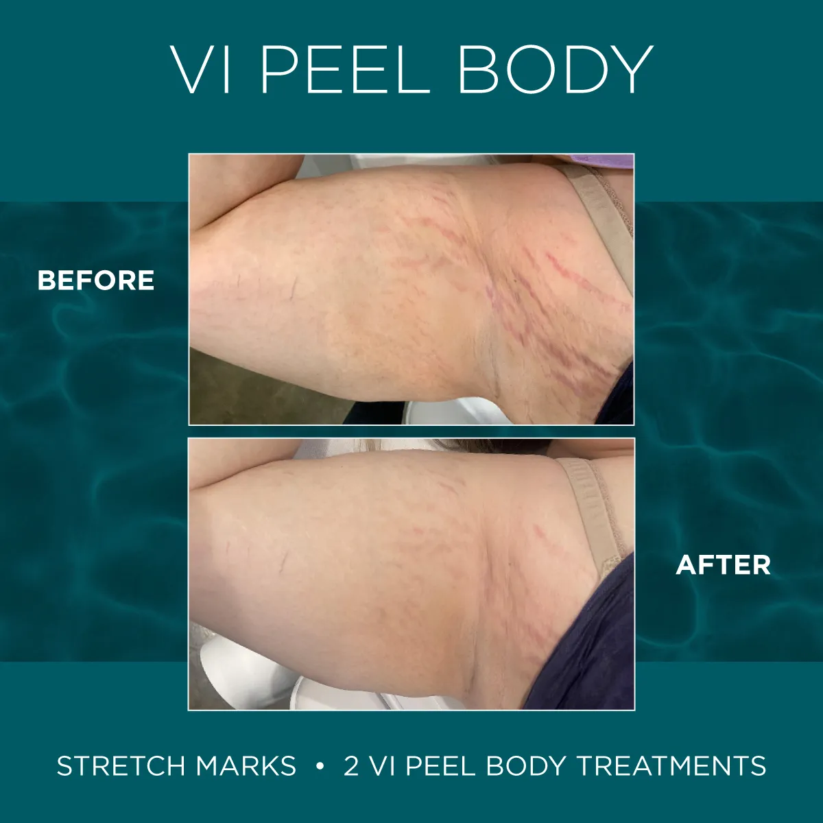 Stretch Marks — Hip & Side, 2 VI Peel Body Treatments
