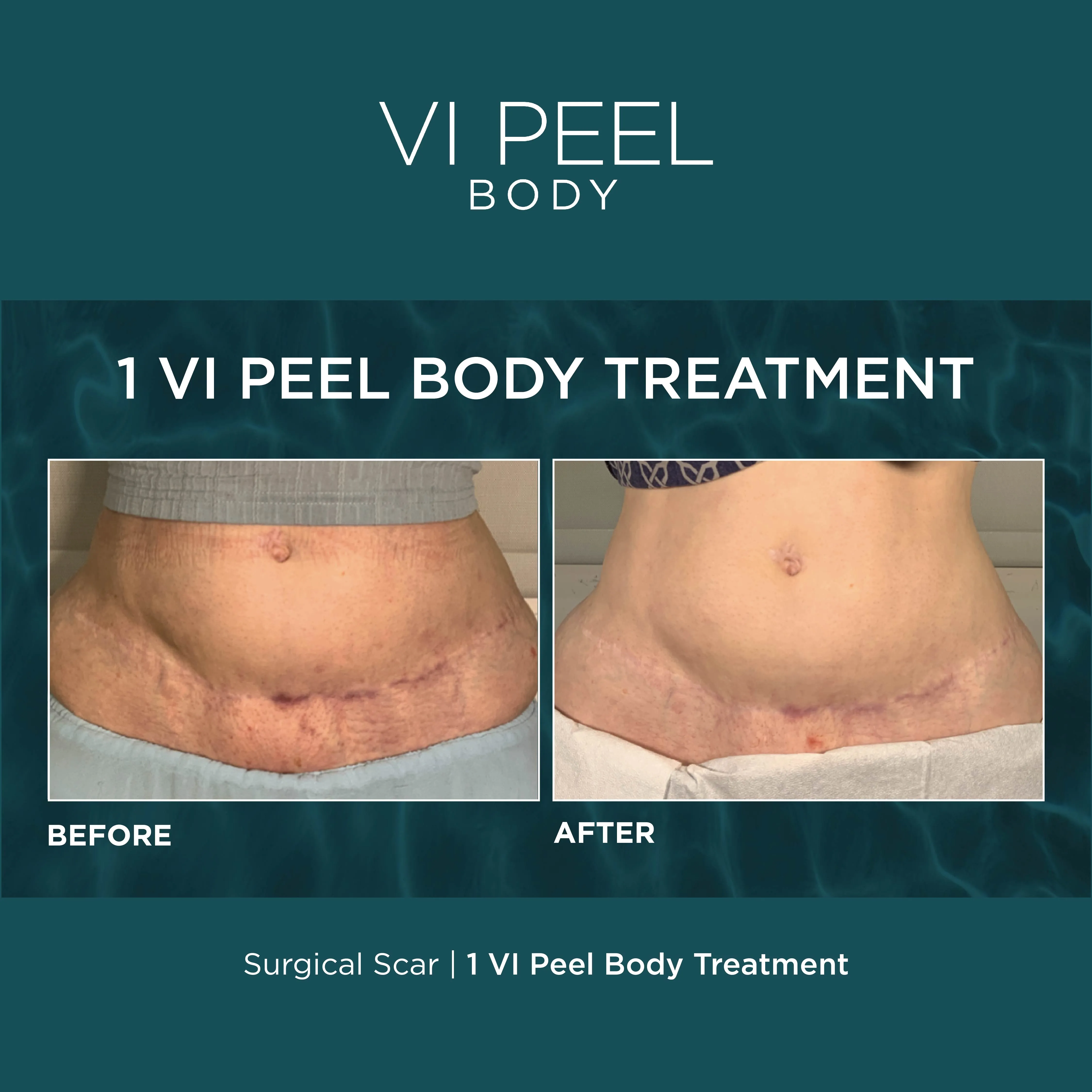 Surgical Scar — Abdomen, 1 VI Peel Body Treatment