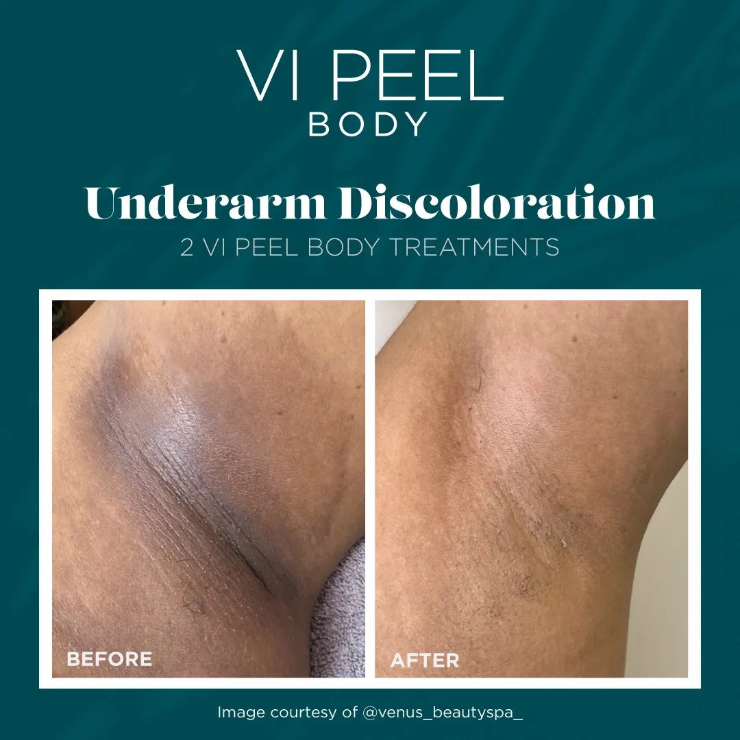 Underarm Discoloration — 2 VI Peel Body Treatments