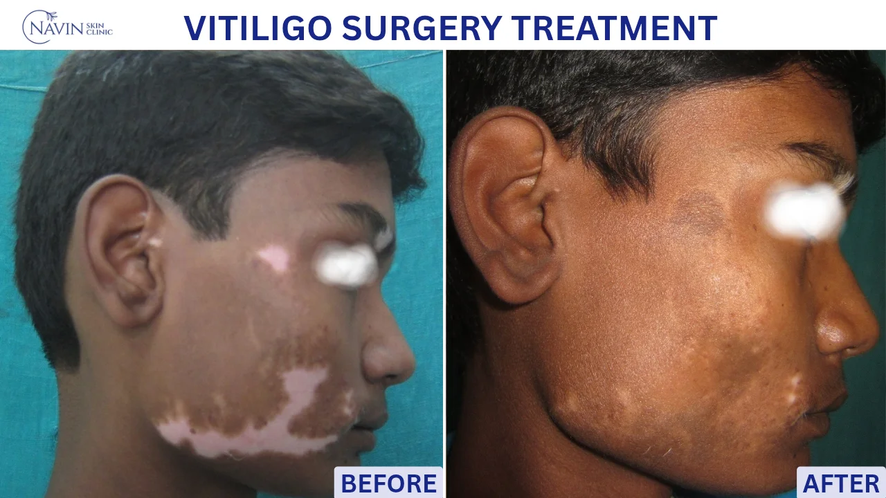 Vitiligo Surgery Treatment - Before
