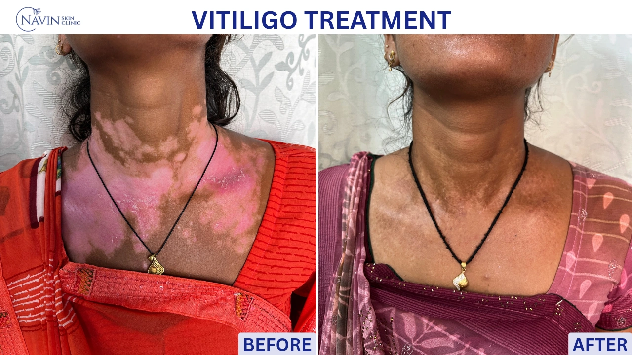 Vitiligo Treatment - Before