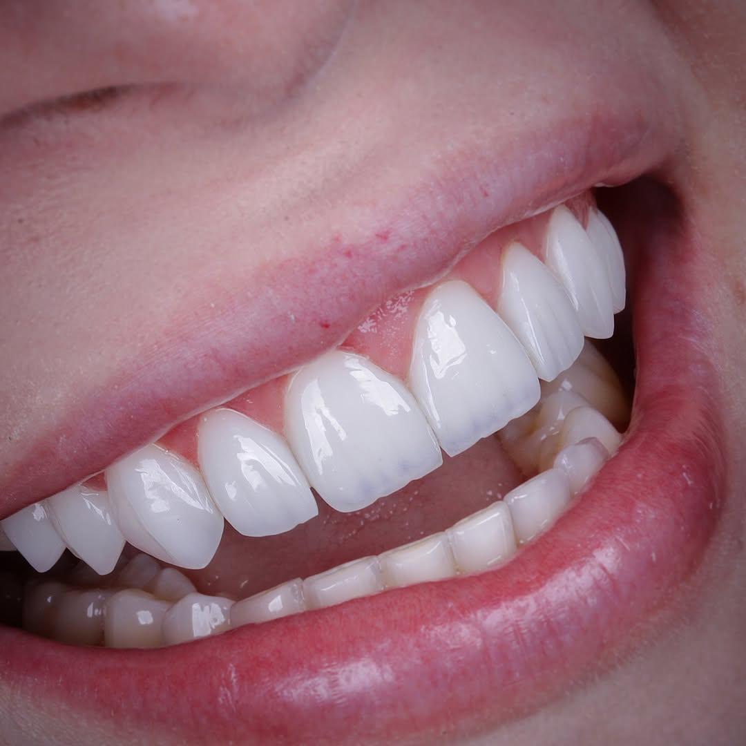 Professional dental care result