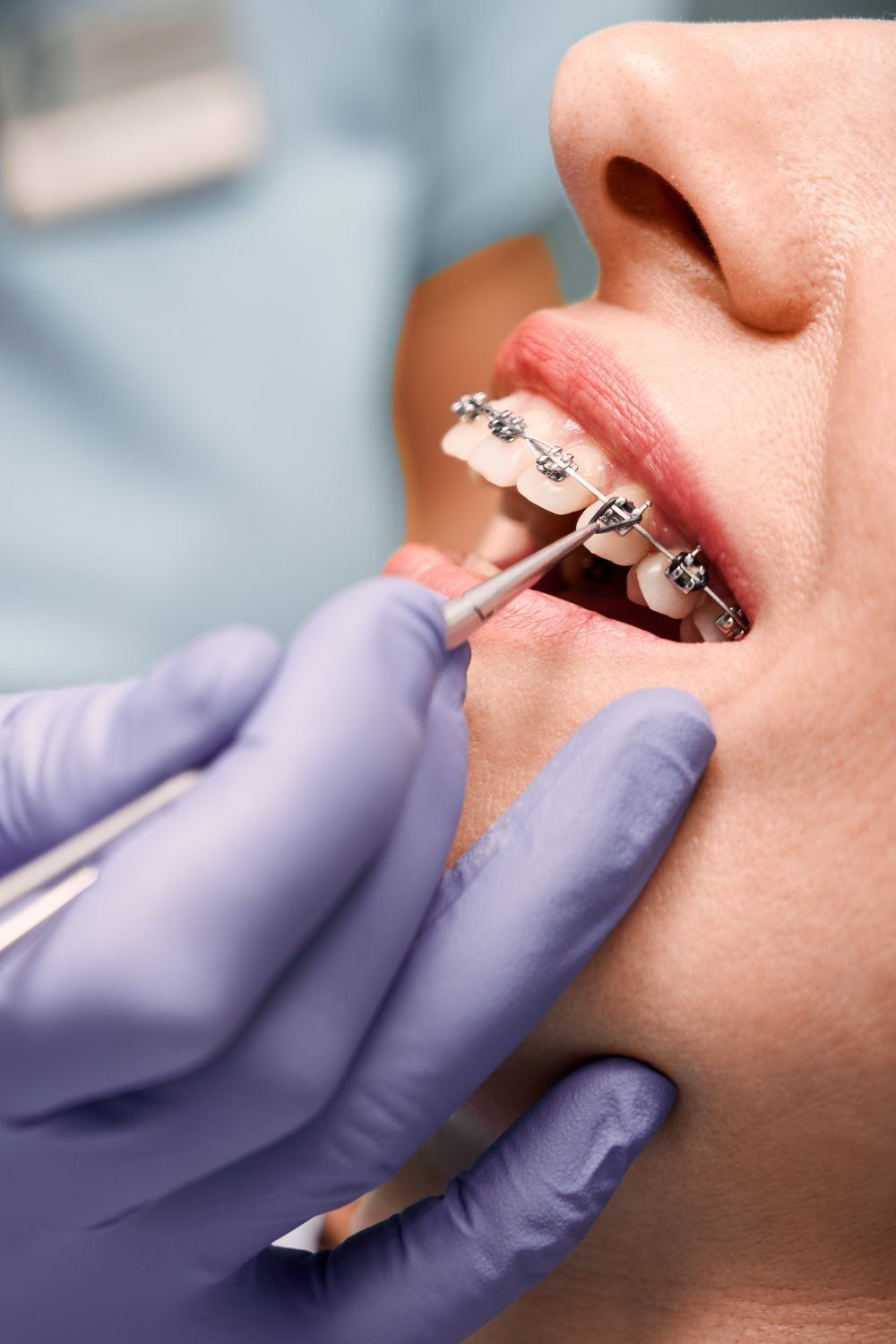 Traditional metal braces