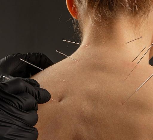 Dry Needling Acupuncture