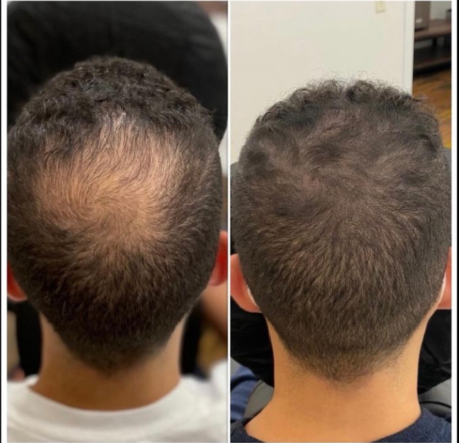 Micropigmentación capilar - antes y después