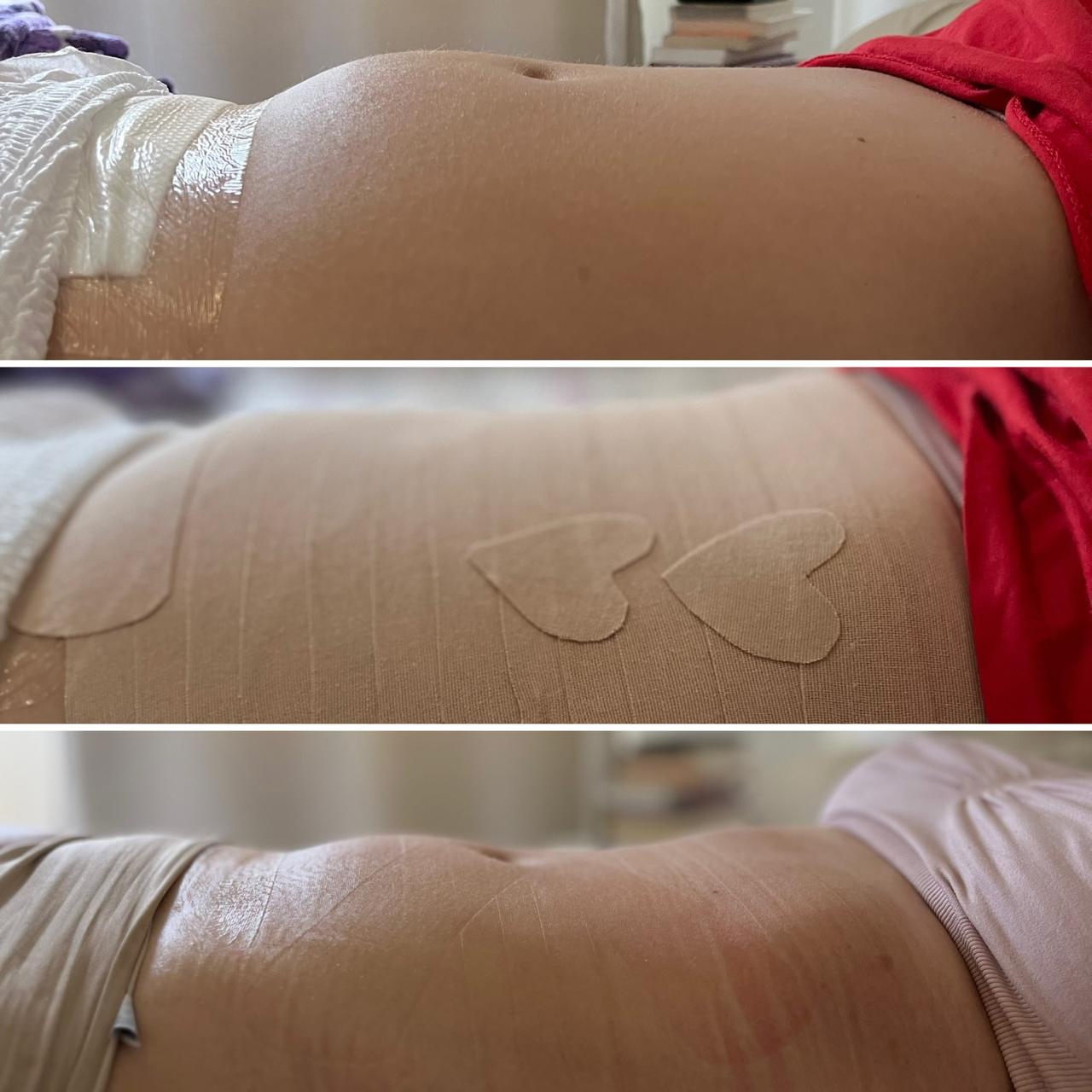 Processo completo do taping: antes, durante e depois