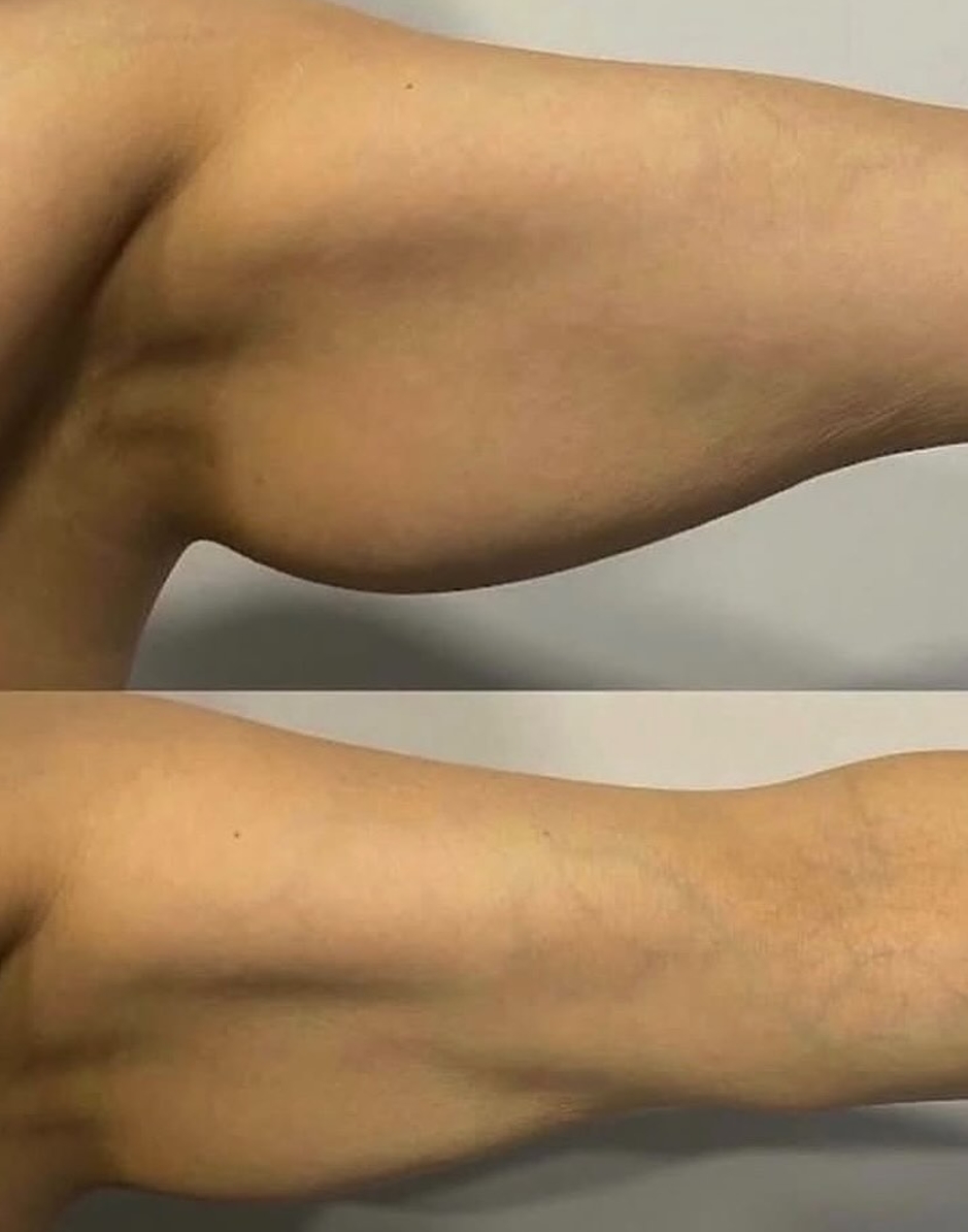 Dipotens Body Firming — Before & After 3