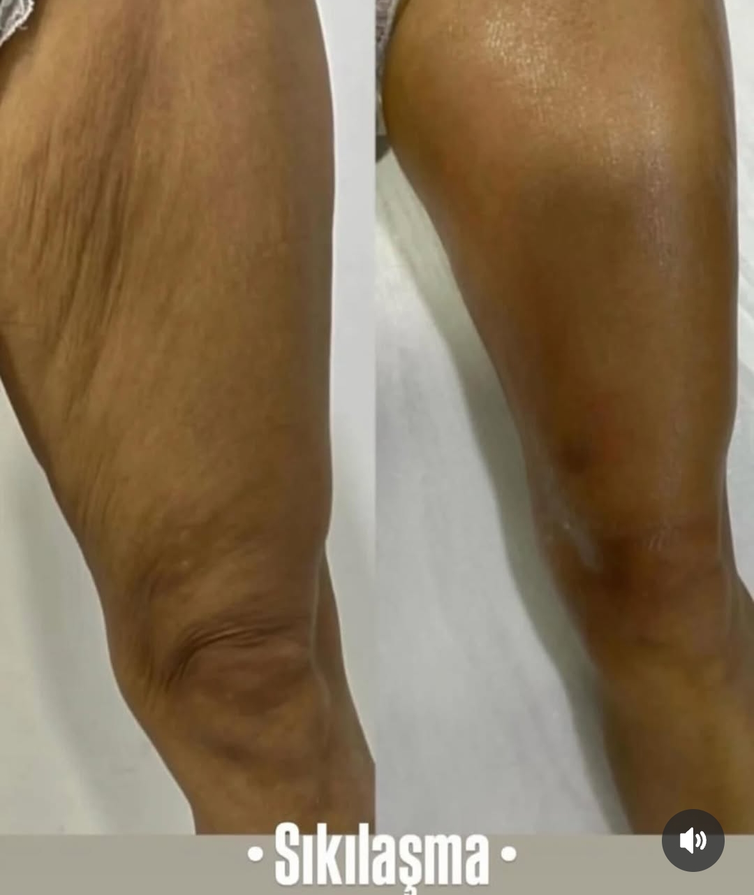 Dipotens Body Firming — Before & After 4